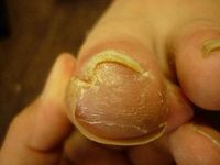 巻き爪ケア 左足親指　R90 L80
