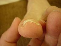 巻き爪ケア 左足親指 Rサイド