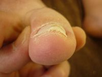 巻き爪ケア 右足親指 Rサイド Lサイド