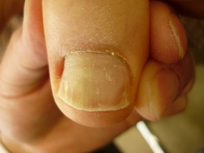 巻き爪ケア 左足親指 Rサイド