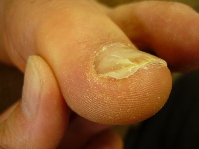 巻き爪ケア 左足親指 Rサイド