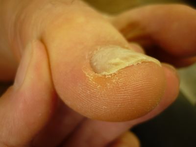巻き爪ケア 左足親指 Rサイド