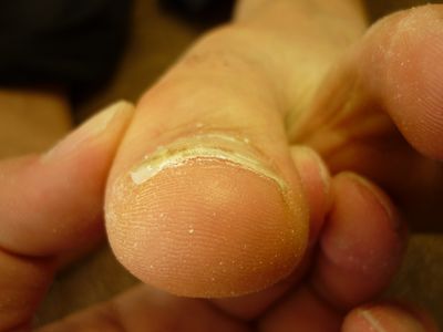 巻き爪ケア 左足親指 Rサイド