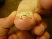 巻き爪ケア 左足親指 Rサイド Lサイド