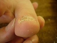 巻き爪ケア 右足親指 Lサイド 左足親指 Rサイド Lサイド