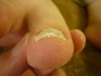 巻き爪ケア 右足親指 Lサイド 左足親指 Rサイド