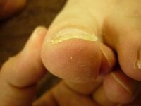 巻き爪ケア 左足親指　Rサイド Lサイド