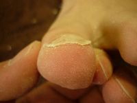 巻き爪ケア 左足親指　Rサイド Lサイド