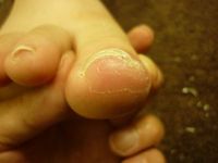 巻き爪ケア 右足親指 L80