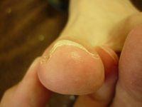 巻き爪ケア 左足親指　R70 L50