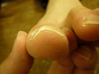 巻き爪ケア 左足親指　両サイド