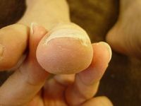 巻き爪ケア 右足親指　L60