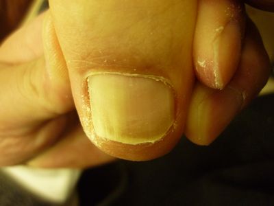 巻き爪ケア 左足親指 R70