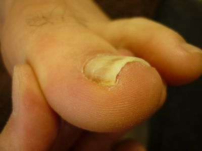 巻き爪ケア 左足親指 R60