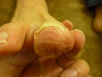 巻き爪ケア 右足親指　★補正完了★