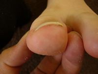 陥入爪の巻き爪ケア　左足親指