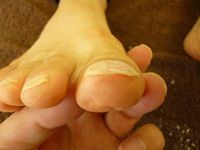 巻き爪ケア 右足親指 L30 左足親指 R30