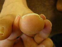 巻き爪ケア　右足親指 L50　左足親指 R50
