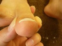 巻き爪ケア右足親指 左足親指 ★補正完了★