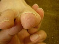 巻き爪ケア　右足親指 L40　左足親指 R40