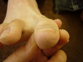 右足親指の巻き爪ケア L60