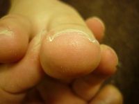 巻き爪ケア　右足親指 L40　左足親指 R50