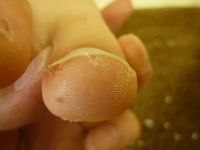 巻き爪ケア 右足親指 L40 左足親指 R50
