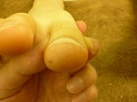 巻き爪ケア 右足親指 R40 L40