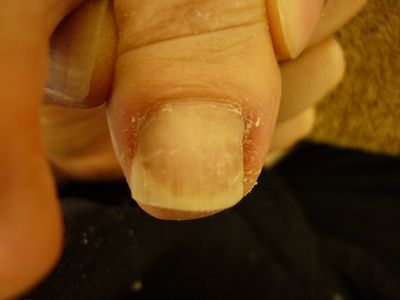 右足親指の巻き爪ケア R40 L40