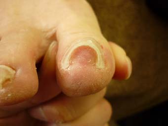 右足親指の巻き爪ケア R60 L70
